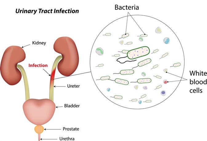 Urinary Tract Infection. Image Credit: joshya / Shutterstock